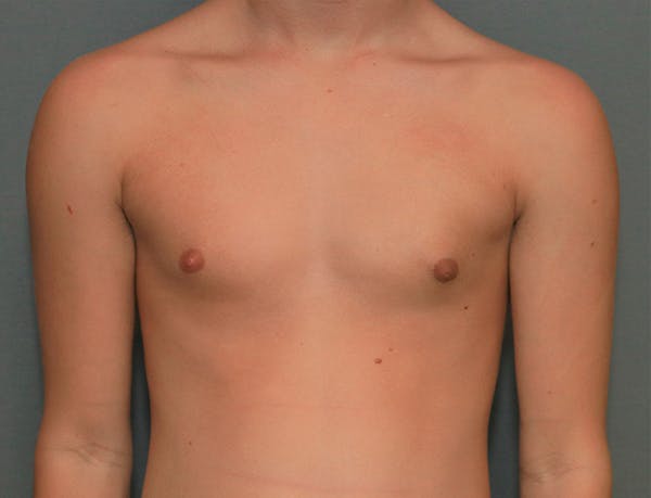 Gynecomastia Before & After Gallery - Patient 8284602 - Image 2
