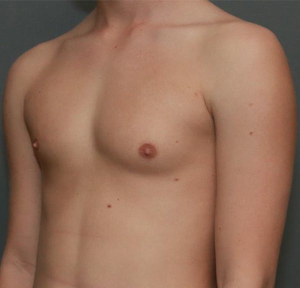 Gynecomastia Before & After Gallery - Patient 5282758 - Image 3