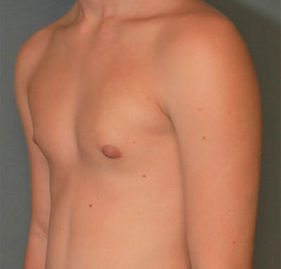 Gynecomastia Before & After Gallery - Patient 5282758 - Image 4