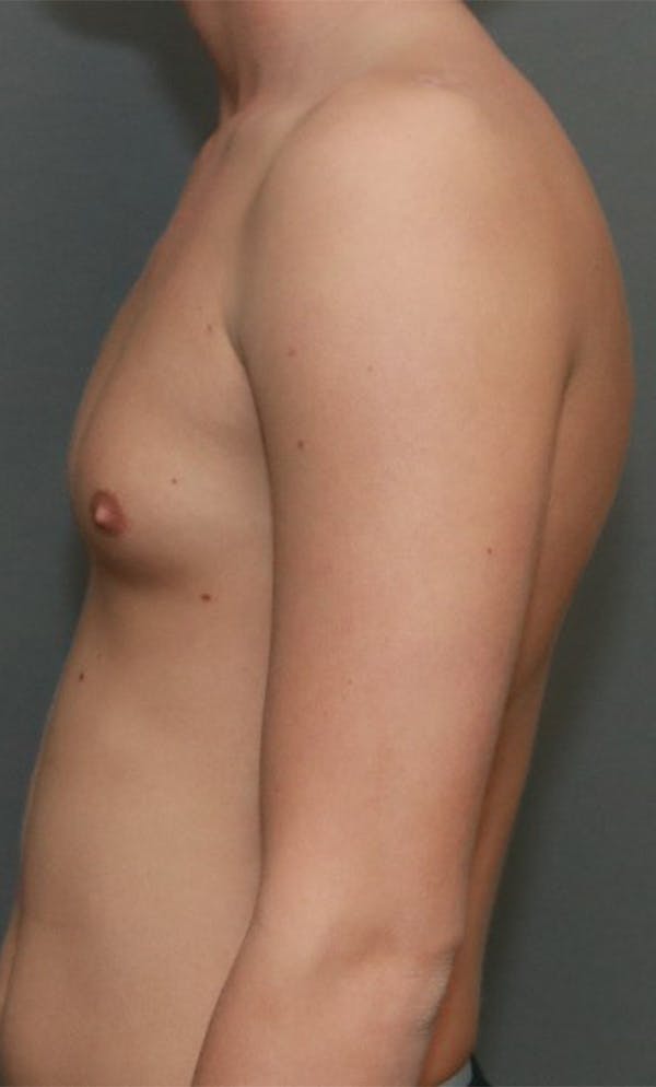 Gynecomastia Before & After Gallery - Patient 8284602 - Image 5