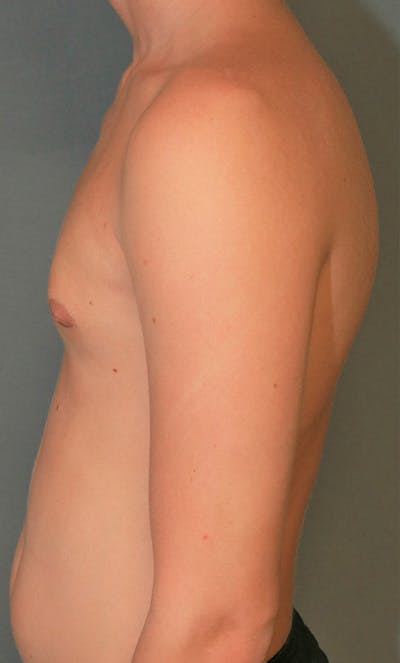 Gynecomastia Before & After Gallery - Patient 8284602 - Image 6