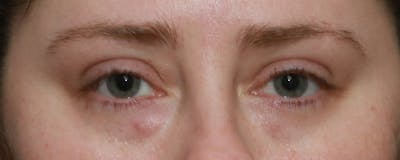 Lower Blepharoplasty Before & After Gallery - Patient 5282807 - Image 1