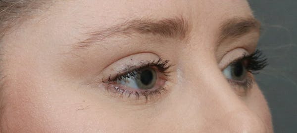Lower Blepharoplasty Before & After Gallery - Patient 5282807 - Image 4