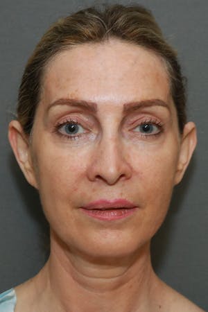 Before and After image of Facelift