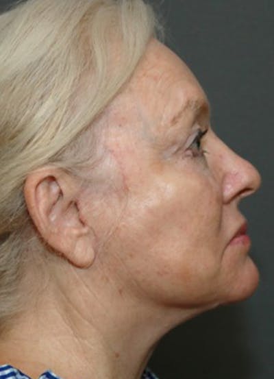 Halo Skin Resurfacing Before & After Gallery - Patient 5556012 - Image 2