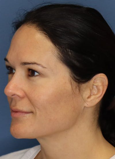 Halo Skin Resurfacing Before & After Gallery - Patient 5556014 - Image 2