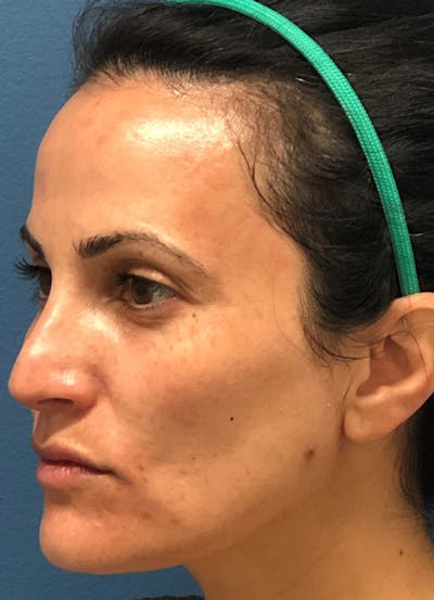 Halo Skin Resurfacing Before & After Gallery - Patient 5556015 - Image 1