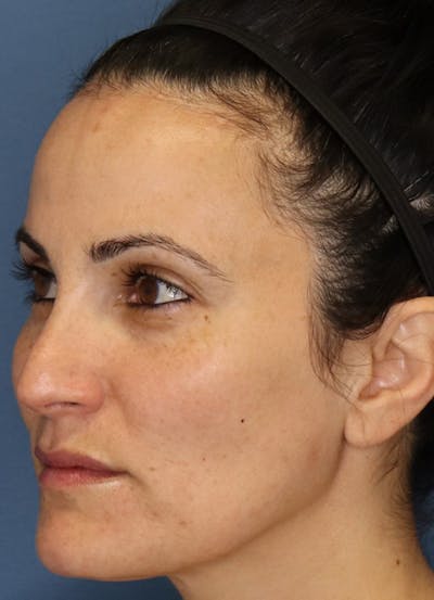 Halo Skin Resurfacing Before & After Gallery - Patient 5556015 - Image 2