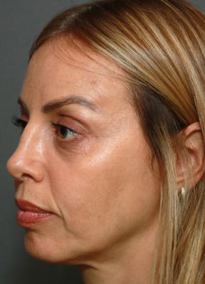 Halo Skin Resurfacing Before & After Gallery - Patient 5556016 - Image 1