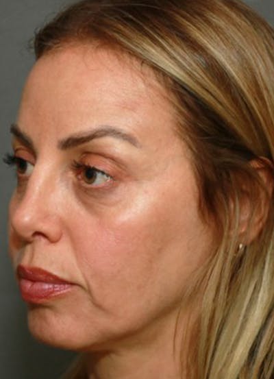 Halo Skin Resurfacing Before & After Gallery - Patient 5556016 - Image 2