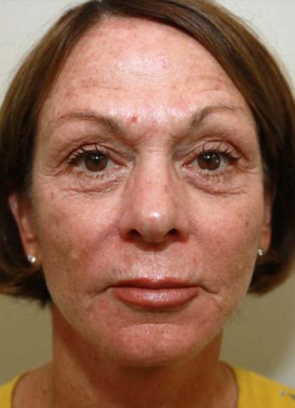 Halo Skin Resurfacing Before & After Gallery - Patient 5556017 - Image 1