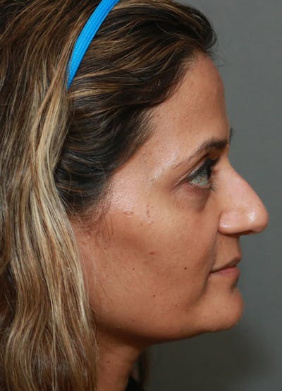 Halo Skin Resurfacing Before & After Gallery - Patient 5556020 - Image 1