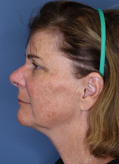 Halo Skin Resurfacing Before & After Gallery - Patient 5556021 - Image 1
