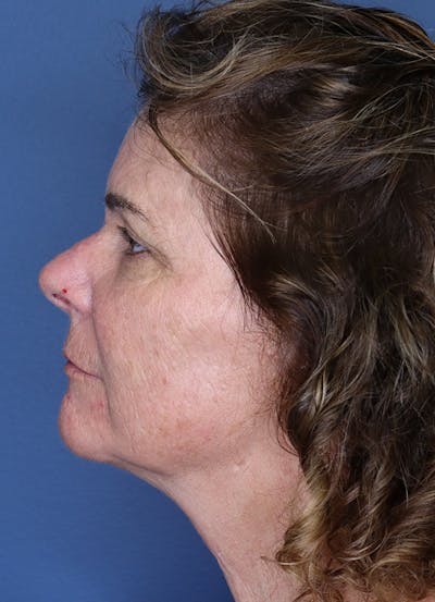 Halo Skin Resurfacing Before & After Gallery - Patient 5556021 - Image 2