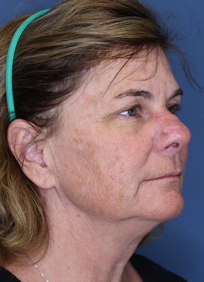 Halo Skin Resurfacing Before & After Gallery - Patient 5556022 - Image 1