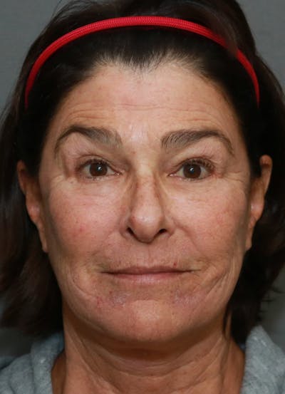 Halo Skin Resurfacing Before & After Gallery - Patient 5556024 - Image 2