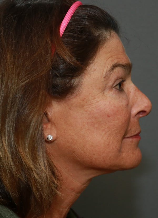 Halo Skin Resurfacing Before & After Gallery - Patient 5556024 - Image 3