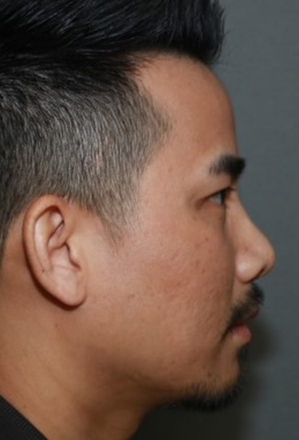 Revision Rhinoplasty Before & After Gallery - Patient 5955015 - Image 5
