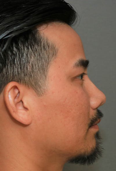 Revision Rhinoplasty Before & After Gallery - Patient 5955015 - Image 6