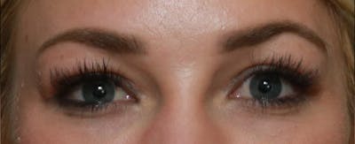 Upper Blepharoplasty Before & After Gallery - Patient 6155684 - Image 1
