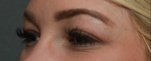 Upper Blepharoplasty Before & After Gallery - Patient 6155684 - Image 3