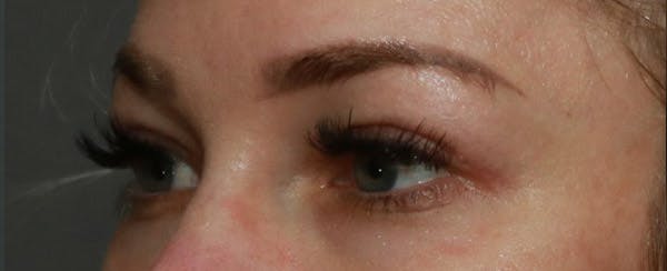 Upper Blepharoplasty Before & After Gallery - Patient 6155684 - Image 4