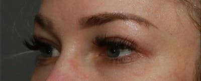 Upper Blepharoplasty Before & After Gallery - Patient 6155684 - Image 4