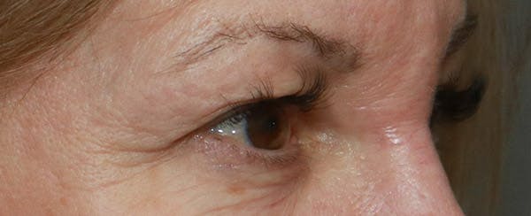 Upper Blepharoplasty Before & After Gallery - Patient 6155685 - Image 3