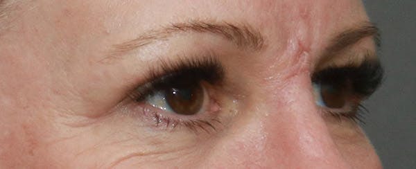 Upper Blepharoplasty Before & After Gallery - Patient 6155685 - Image 4