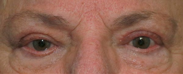 Upper Blepharoplasty Before & After Gallery - Patient 6155686 - Image 2