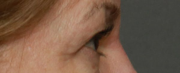 Upper Blepharoplasty Before & After Gallery - Patient 6155685 - Image 5