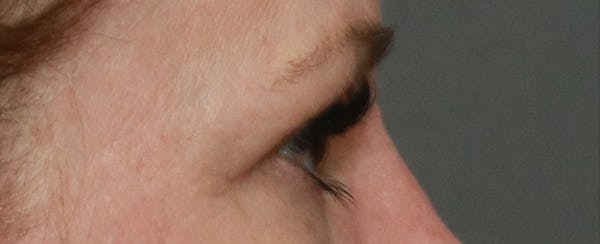 Upper Blepharoplasty Before & After Gallery - Patient 6155685 - Image 6