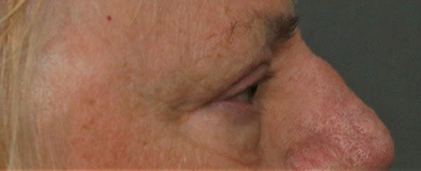 Upper Blepharoplasty Before & After Gallery - Patient 6155686 - Image 3