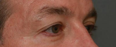 Upper Blepharoplasty Before & After Gallery - Patient 6155687 - Image 1