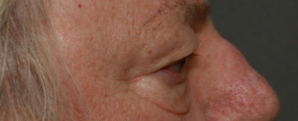 Upper Blepharoplasty Before & After Gallery - Patient 6155686 - Image 4