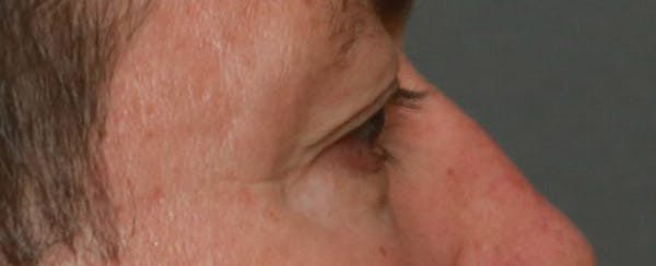 Upper Blepharoplasty Before & After Gallery - Patient 6155687 - Image 3