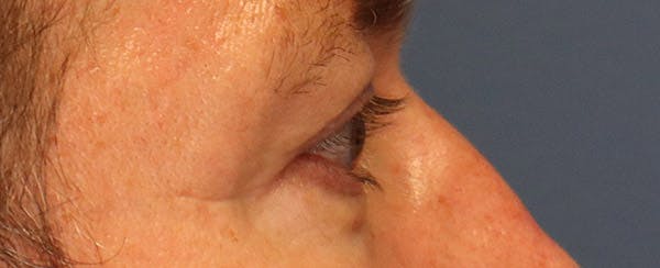Upper Blepharoplasty Before & After Gallery - Patient 6155687 - Image 4