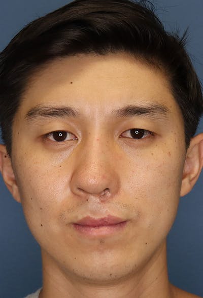 Revision Rhinoplasty Before & After Gallery - Patient 6279570 - Image 2