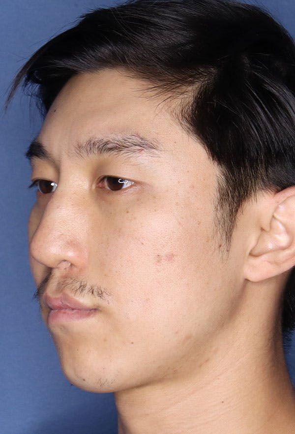 Revision Rhinoplasty Before & After Gallery - Patient 6279570 - Image 3