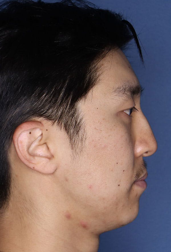 Revision Rhinoplasty Before & After Gallery - Patient 6279570 - Image 7