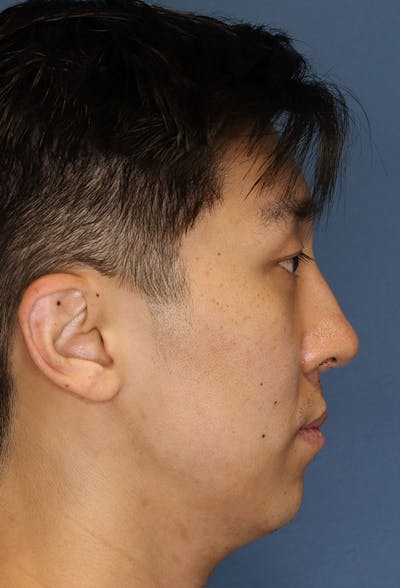 Revision Rhinoplasty Before & After Gallery - Patient 6279570 - Image 8