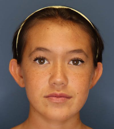 Otoplasty Before & After Gallery - Patient 6610804 - Image 1