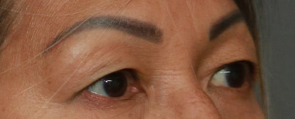 Upper Blepharoplasty Before & After Gallery - Patient 7303604 - Image 3