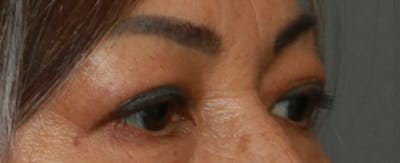 Upper Blepharoplasty Before & After Gallery - Patient 7303604 - Image 4