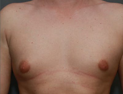 Gynecomastia Before & After Gallery - Patient 7329083 - Image 1