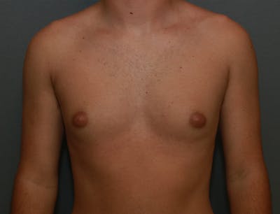 Gynecomastia Before & After Gallery - Patient 8284604 - Image 1