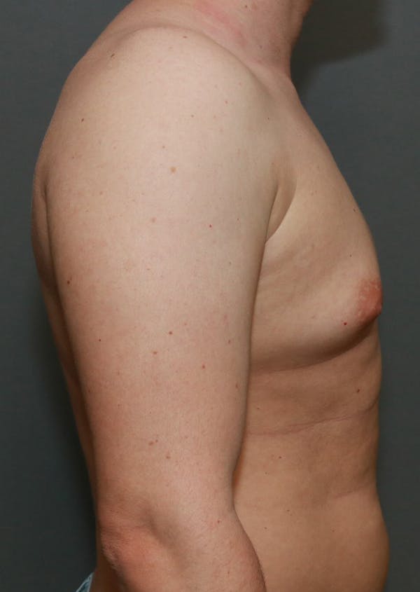 Gynecomastia Before & After Gallery - Patient 8284603 - Image 3
