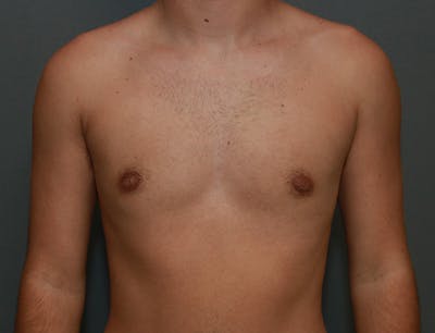 Gynecomastia Before & After Gallery - Patient 8284604 - Image 2