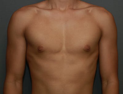 Gynecomastia Before & After Gallery - Patient 7329085 - Image 1