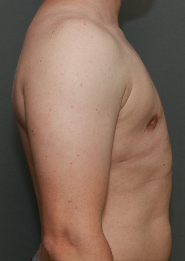 Gynecomastia Before & After Gallery - Patient 8284603 - Image 4